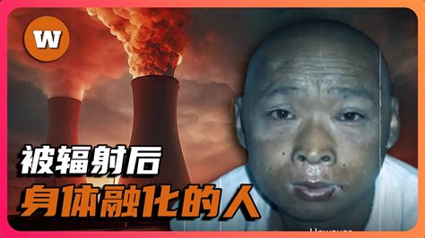 被輻射過的人|核輻射如何對人體造成傷害？